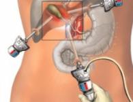 The use of laparoscopic methods when removing the uterus