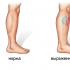 Why legs are swollen: causes and methods of treatment