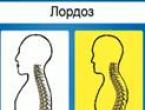 Posture disorder test